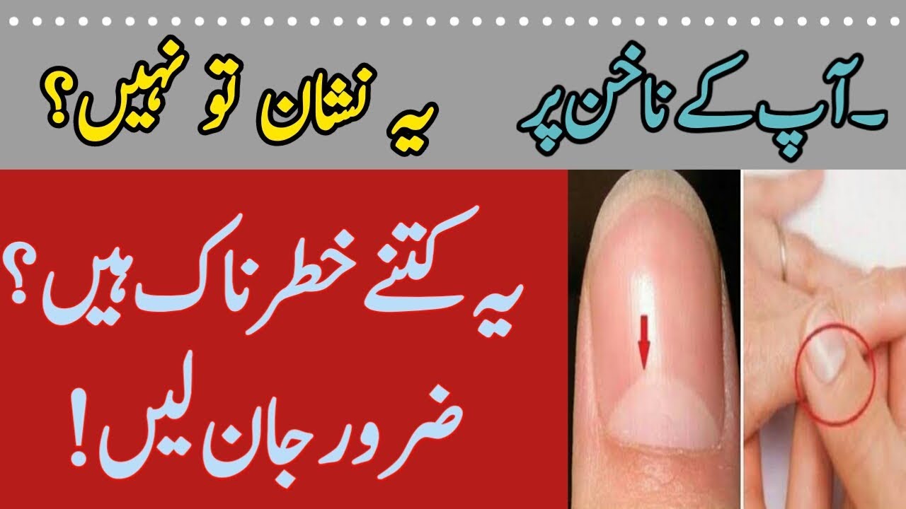 Nails Par Sufaid Nishan Ka MatlabWhat Causes White Marks